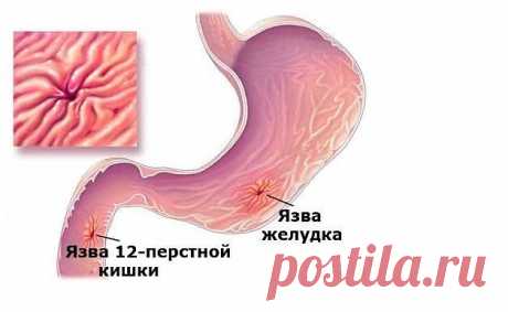 Народные рецепты для лечения язвы желудка и 12-перстной кишки. | OK.RU