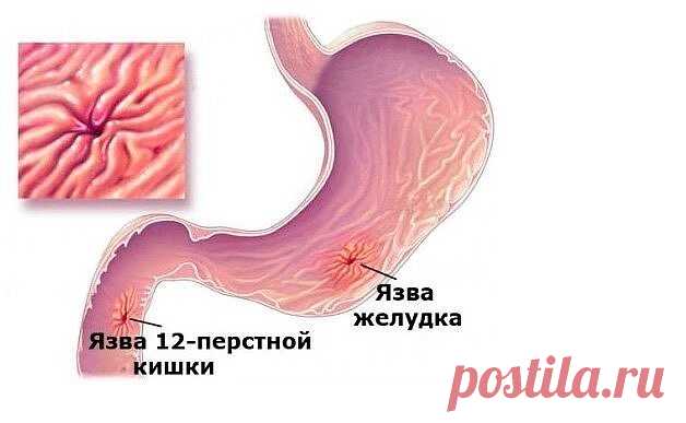 Народные рецепты для лечения язвы желудка и 12-перстной кишки. | OK.RU