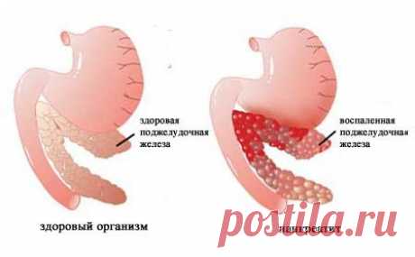Заболевания поджелудочной железы.Симптомы и лечение поджелудочной железы народными средствами.