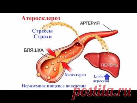 Холестерин. Вред статинов