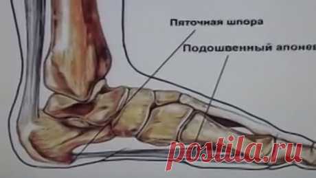 Как самому вылечить пяточную шпору, самый эффективный метод!!!