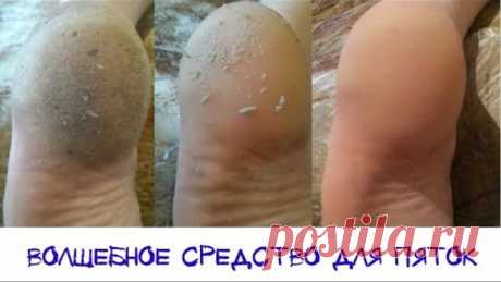 Волшебное средство для пяток. Моментальный эффект!