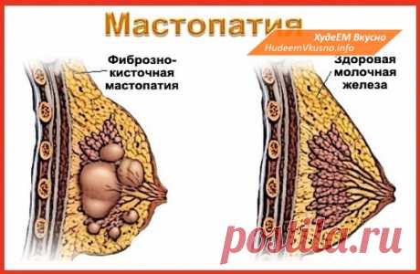 МАСТОПАТИЯ БОИТСЯ ВАЛЕРИАНЫ И ЗВЕРОБОЯ | Худеем Вкусно