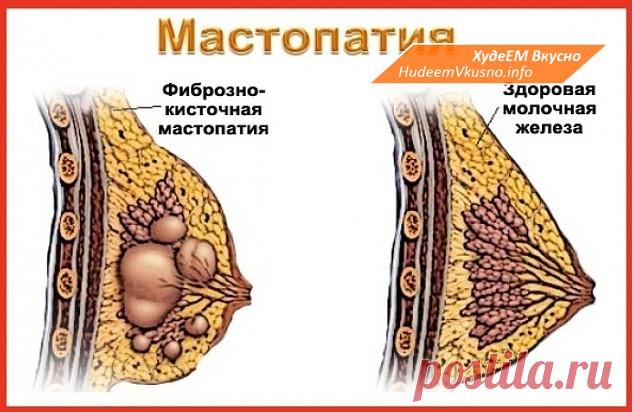 МАСТОПАТИЯ БОИТСЯ ВАЛЕРИАНЫ И ЗВЕРОБОЯ | Худеем Вкусно