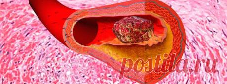 Профилактика образования тромбов | pokolenie-x.com