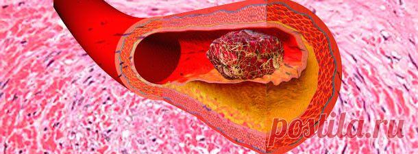 Профилактика образования тромбов | pokolenie-x.com