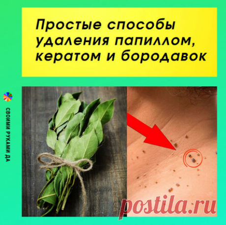 Простые способы удаления папиллом, кератом и бородавок