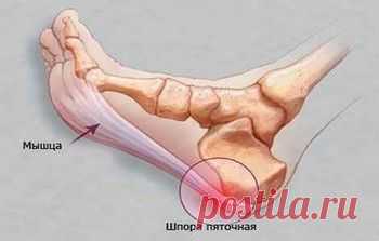 Пяточная шпора. Рецепты народной медицины