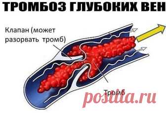 ТРОМБОЗ ГЛУБОКИХ ВЕН. 
 такой рецепт: 1 стакан сока репчатого лука (только не синего) и 1 стакан меда смешать и держать этот состав 3 дня при комнатной температуре, а затем поставить в холодильник на 10 дней. Пить по 1 столовой ложке за 30 минут до еды 3 раза в день.