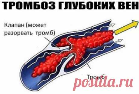 ТРОМБОЗ ГЛУБОКИХ ВЕН.
такой рецепт: 1 стакан сока репчатого лука (только не синего) и 1 стакан меда смешать и держать этот состав 3 дня при комнатной температуре, а затем поставить в холодильник на 10 дней. Пить по 1 столовой ложке за 30 минут до еды 3 раза в день.