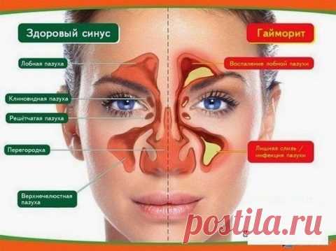 Лечение гайморита народными средствами / Будьте здоровы