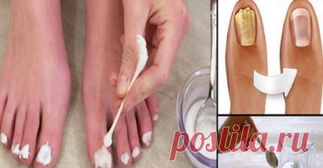Нанесите это средство на ногти, и через 15 минут о грибке можно будет забыть!
Средство из 3 компонентов избавит от такой ужасной проблемы, как грибок ногтей. Все знают, что это заболевание сопровождается неприятным запахом, исходящим от ног.
Также чешется и зудит кожа, может даже облезать, разрушается ногтевая пластина… Но, применяя это средство от грибка на ногах 2 раза в день, вы полностью вылечите заболевание даже без аптечных препаратов!
средство против грибка ногтей на ногах
ПОНАДОБИТС