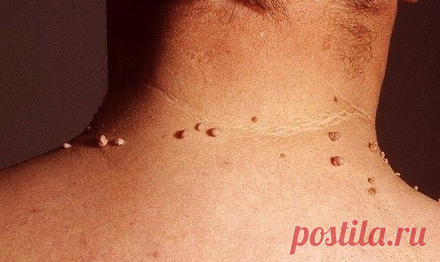 ШЕСТЬ РЕЦЕПТОВ УДАЛЕНИЯ ПАПИЛЛОМ — Полезные советы