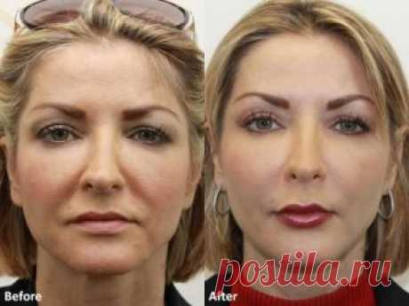 Даже самая дряблая кожа лица подтянется после этой процедуры! Делай это раз в неделю