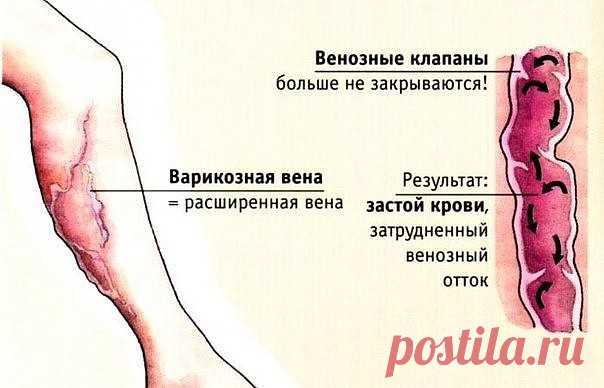 КАК РАЗБЛОКИРОВАТЬ СЕДАЛИЩНЫЙ НЕРВ
Как разблокировать седалищный нерв: 2 простых способа снять боль
Седалищный нерв свое начало берет в поясничном отделе позвоночника и, проходя через ягодицы, тянется к ступне. Поэтому боль при его защемлении чувствуется особенно сильно. 
Как правило, термин «защемление/ущемление седалищного нерва» подразумевает потерю эластичности и гибкости мышц задней поверхности ноги. Это часто связано с процессом возрастного укорочения (ригидности) мы...