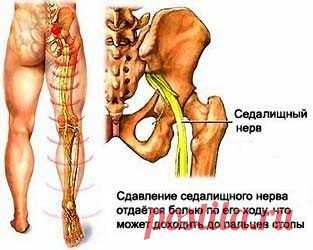 КАК УСТРАНИТЬ БОЛЬ В НОГЕ ОТ ВОСПАЛЕНИЯ СЕДАЛИЩНОГО НЕРВА?