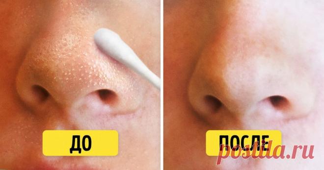 10 натуральных средств, которые спасут лицо от черных точек