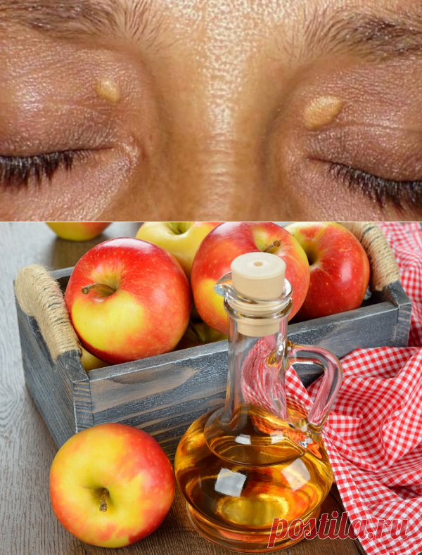 Фибромы и бородавки больше не появятся! Краткий путь к здоровой коже. | АйДаМы | У нас Всегда лучшее