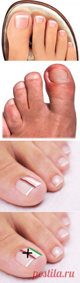 ВРОСШИЙ НОГОТЬ Самое эффективное самостоятельное исправление | Я ЗДОРОВ!