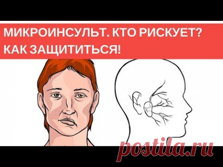 После микроинсульта. Что срочно начать делать?