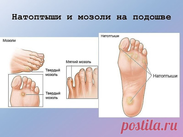 НАРОДНЫЕ МЕТОДЫ ОТ МОЗОЛЕЙ