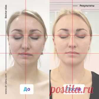 Результат работы врача-остеопата Алеся Улищенко.
Узнать о докторе и записаться на приём: www.dr-ales.com 

Девушка обратилась с желанием исправить асимметрию лица, которая у неё с самого детства. 
Это один из сложных случаев для исправления у взрослого человека, так как эта асимметрия появилась очень давно! Скорее всего, она сформировалась вследствие родовой травмы.
Показать полностью…