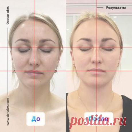 Результат работы врача-остеопата Алеся Улищенко.
Узнать о докторе и записаться на приём: www.dr-ales.com 

Девушка обратилась с желанием исправить асимметрию лица, которая у неё с самого детства. 
Это один из сложных случаев для исправления у взрослого человека, так как эта асимметрия появилась очень давно! Скорее всего, она сформировалась вследствие родовой травмы.
Показать полностью…