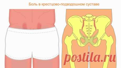 Крестцово-подвздошный сустав. Как разблокировать SI сустав