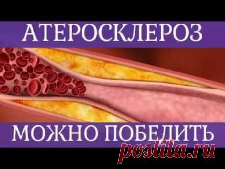 ❤ Как победить атеросклероз