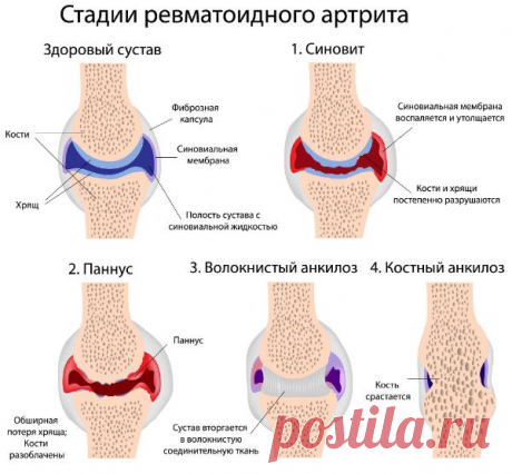 БЛОГ ПОЛЕЗНОСТЕЙ: СУПЕРЛЕЧЕНИЕ - КАРТОФЕЛЬ НА КЕФИРЕ ПРОТИВ АРТРИТА