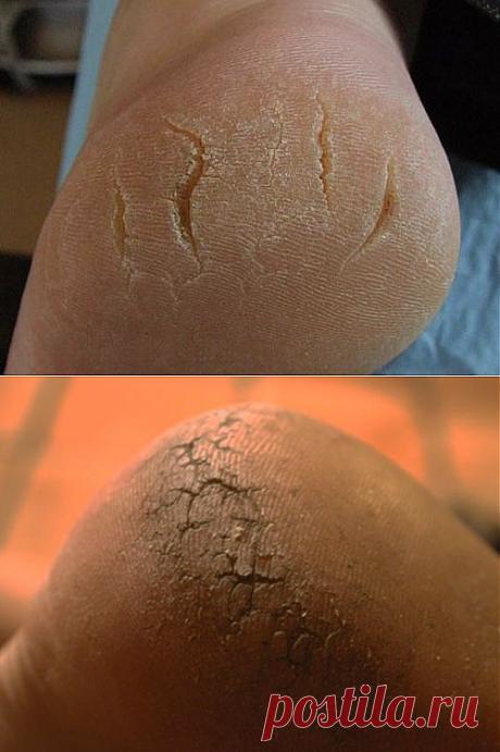 Трещины на пятках: причины и лечение | Сам себе Гиппократ