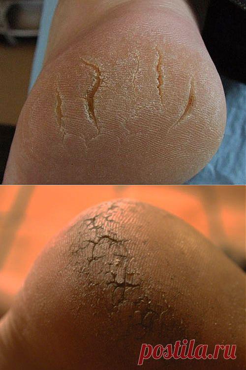 Трещины на пятках: причины и лечение | Сам себе Гиппократ