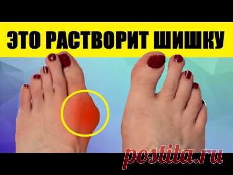 Вот Что Растворит Шишку На Ноге! Выпирающая Косточка Втягивается Мгновенно, Возьмите Обычный...