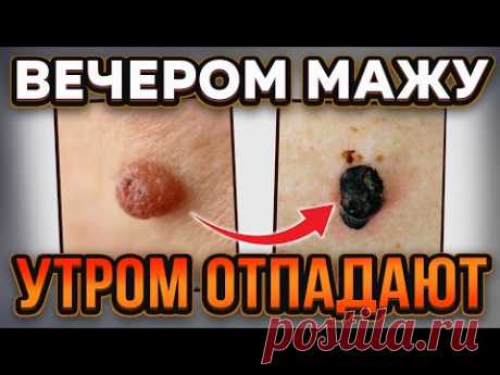 Старый дерматолог: врачи растворяют бородавки и папилломы домашними средствами, а именно...