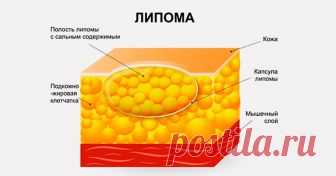 Вот, как избавиться от липомы быстро и легко! 4 народных рецепта со 100% эффективностью! Если липома появилась, сразу предпринимайте меры! Не затягивайте с визитом к врачу! Липома — это доброкачественная опухоль, которая состоит из жировой ткани. Она не доставляет особого дискомфорта, но...