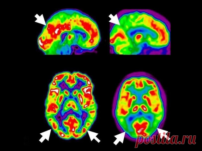 9 привычек, которые вам следует соблюдать, чтобы остановить деменцию и болезнь Альцгеймера, прежде чем она начнется! Очень эффективно! Что такое деменция? Деменция — это не болезнь, но на самом деле симптомы вызывают другие симптомы или травмы, которые воздействуют на