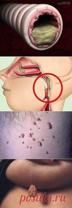 СЛИЗЬ В ОРГАНИЗМЕ. ОТКУДА БЕРЁТСЯ, ЧЕМ ОПАСНА И КАК ВЫВОДИТЬ.