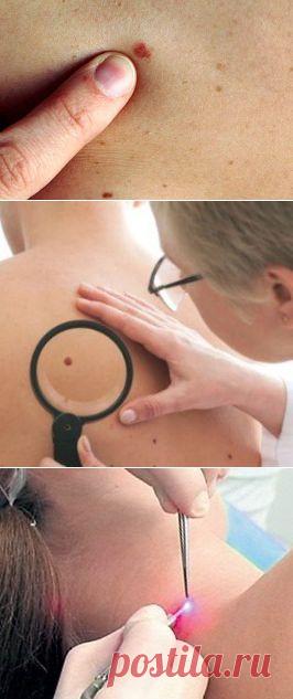Красные родинки на теле / Будьте здоровы