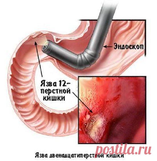 Язва двенадцатиперстной кишки - симптомы и лечение