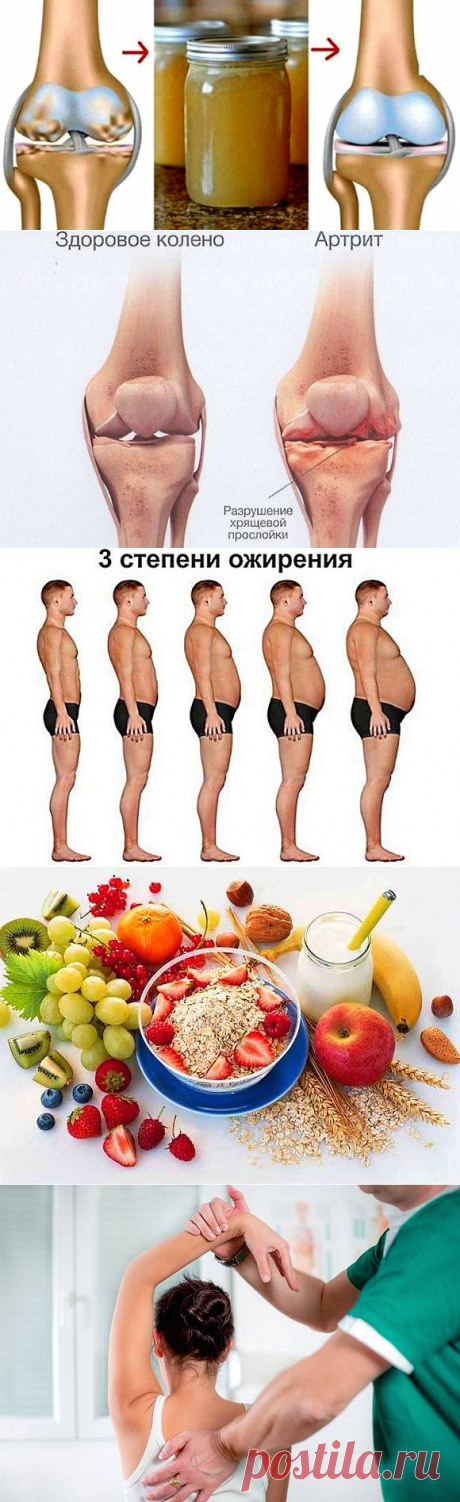 Лечение артрита народными средствами в домашних условиях