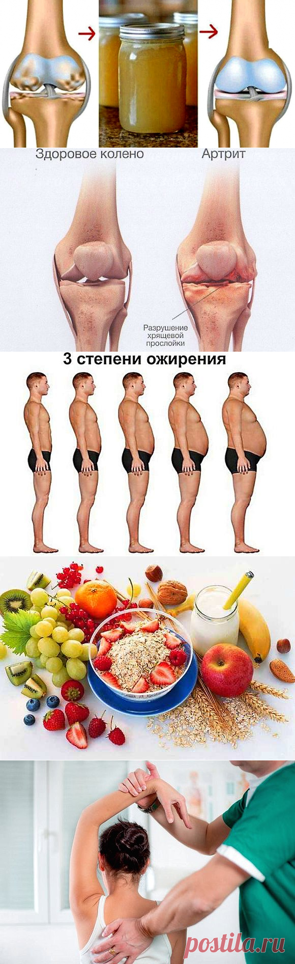 Лечение артрита народными средствами в домашних условиях