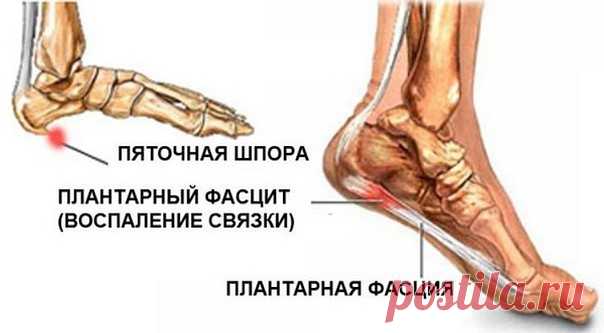 ЭФФЕКТИВНАЯ МАЗЬ ОТ ПЯТОЧНОЙ ШПОРЫ 

Есть одно из эффективных народных средств лечения пяточной шпоры – это мазь, приготовленная из яйца, сливочного масла и уксуса. Также нам понадобится баночка с крышкой, по емкости чтобы соответствовала стакану. Но если такой нет, то можно использовать обычный стакан. 
 
Берем ингредиенты: 
 
яйцо – 1 шт (свежее); 
сливочное натуральное несоленое масло - 200 граммов; 
Столовый уксус - берем столько, чтобы хватило залить яйцо в стакане. У...