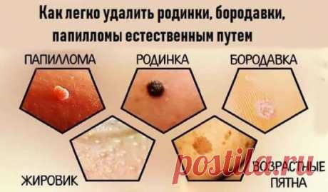 Как легко удалить родинки, бородавки, папилломы естественным путем