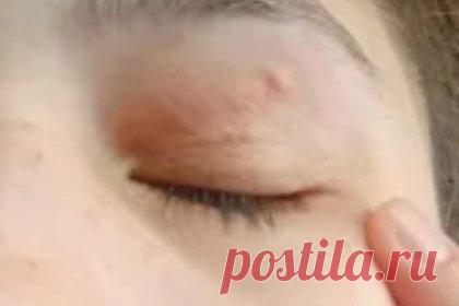 Из глаза девушки удалили 11-сантиметрового червя