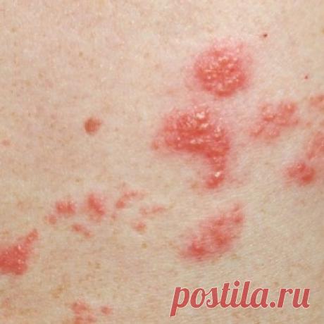 Если была ветрянка, обязательно прочти это! Как лечить опоясывающий лишай.