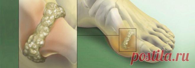 Откуда берется подагра | Квинтэссенция Здоровья