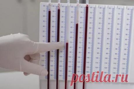 СОЭ 35 у женщины, что это значит? Понятие скорости оседания эритроцитов, его нормальный уровень в зависимости от пола и возраста, физиологические и патологические причины изменения.