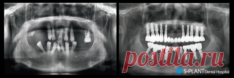 Имплантация не затрудняет повседневную жизнь? :: S-PLANT Dental Hospital / 에스플란트