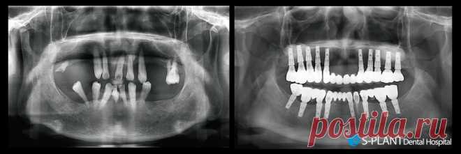 Имплантация не затрудняет повседневную жизнь? :: S-PLANT Dental Hospital / 에스플란트