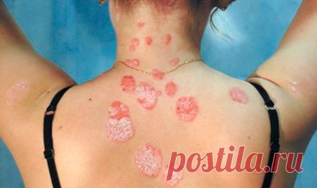 Дәрі-дәрмектер мен физиотерапия арқылы препараттың бейімділігін сенімді түрде қалай жоюға болады: Барлық алдын-алу туралы, менің оқырмандарым! Ұрықтандыруды қалай жоюға болады? - интернет-коммуникацияларды жиі қолданатын мәселе. Бұған дейін, оны алып тастау үшін, бұл патрульдің көрінісі екенін түсіну керек. Попиаз - бұл сыртқы сілекейге, сондай-ақ жалаңаштауға және шашқа әсер ететін жұмсақ ауру. Фобияда немесе қышқылдан айырылу кезінде дерматологиялық аурулардан зардап шек...